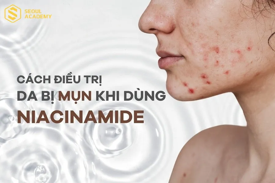 Kết hợp Niacinamide với các hoạt chất mạnh cùng lúc không đúng cách khiến làn da bị kích ứng