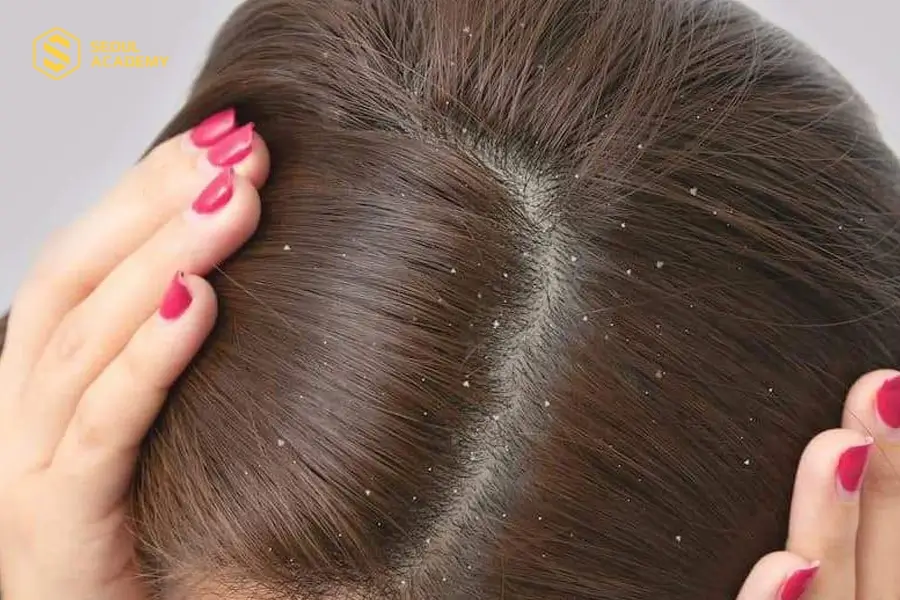 Sử dụng Dạ Hương trị nấm da đầu cần đảm bảo thực hiện đúng cách