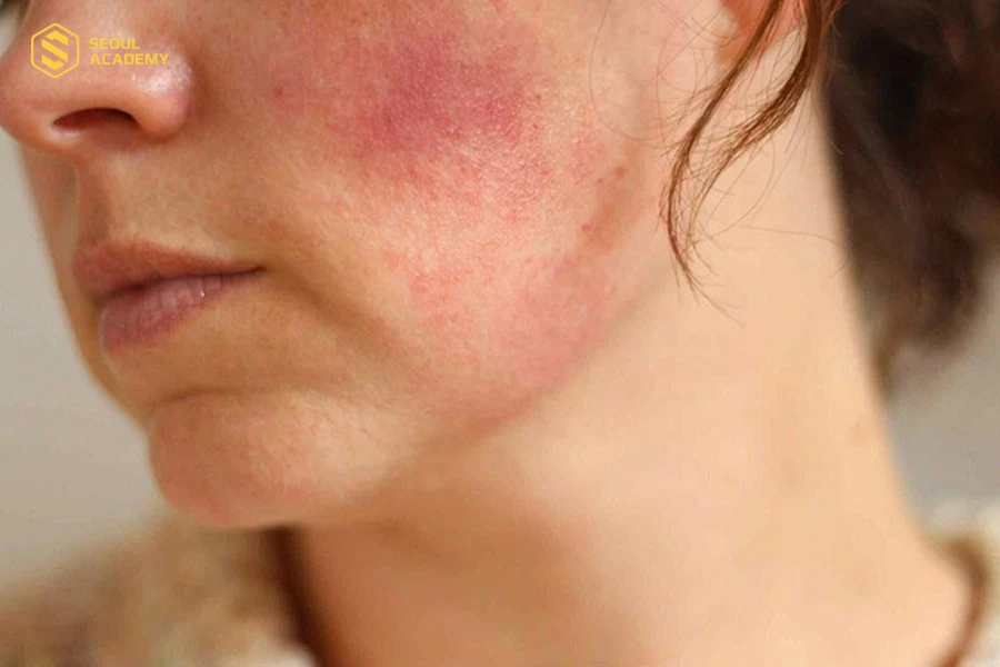 Da kích ứng có thể xuất hiện mẩn đỏ và mụn li ti xung quanh mặt