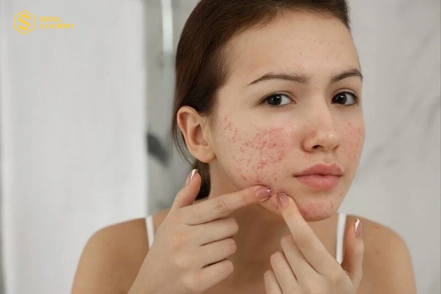 Tuyệt đối không nặn mụn khi da đang ngứa và kích ứng