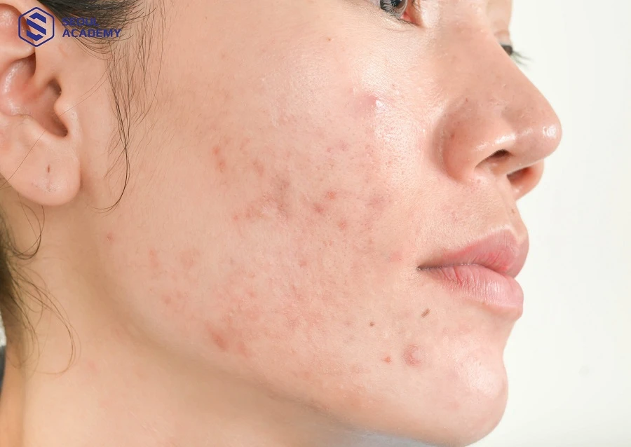 Purging là tình trạng đẩy nhân mụn cũ ẩn sâu dưới da lên trên bề mặt