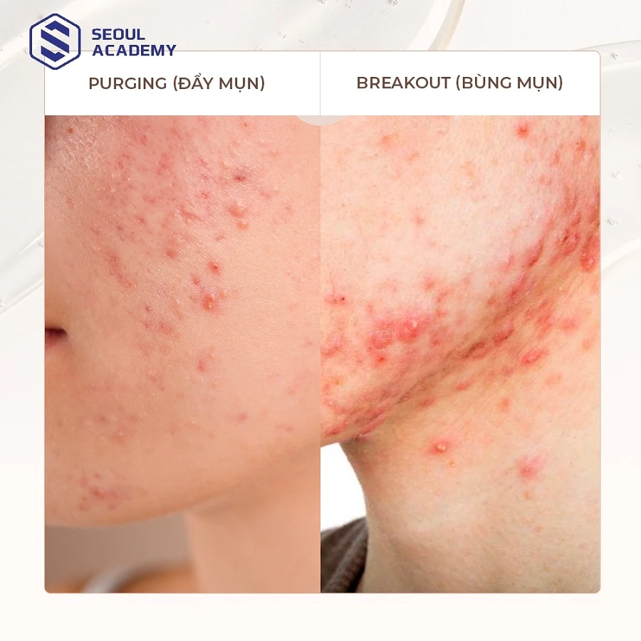Purging hay Breakout là những hiện tượng nhiều người bị nhầm lẫn