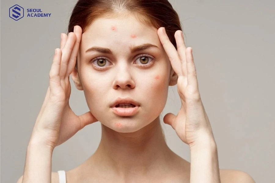 Nếu làn da bị nổi mụn kích ứng bạn nên ngưng sử dụng các sản phẩm lạ và quay về chu trình chăm sóc da tối giản