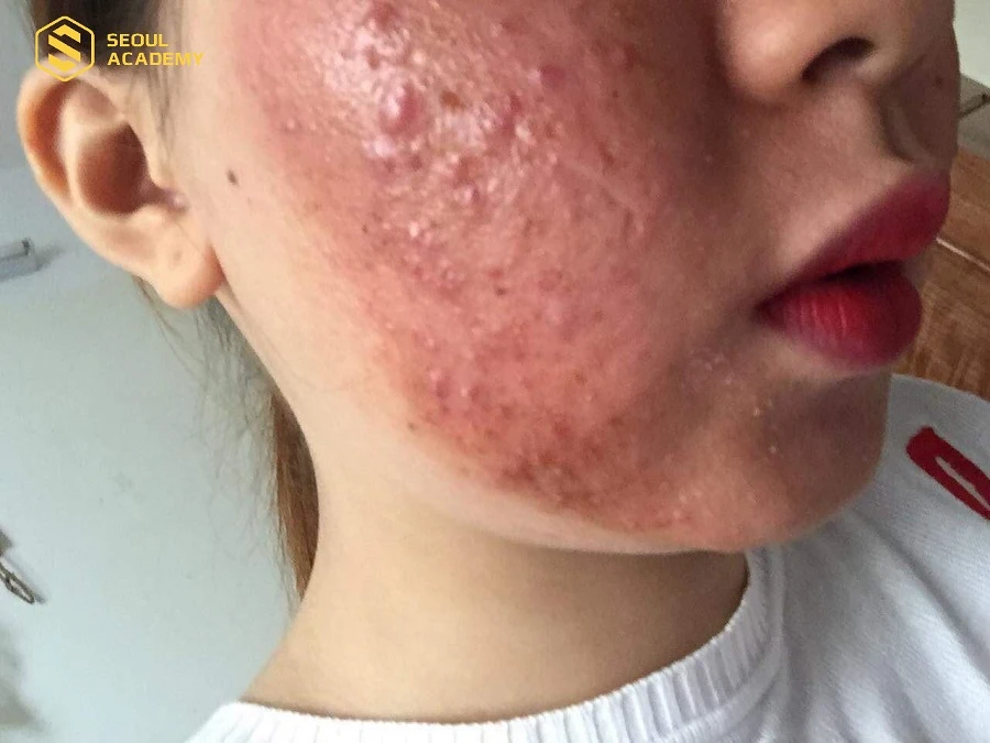 Nếu ngưng sử dụng kem trộn đột ngột có thể khiến da bị sốc và tình trạng tồi tệ hơn