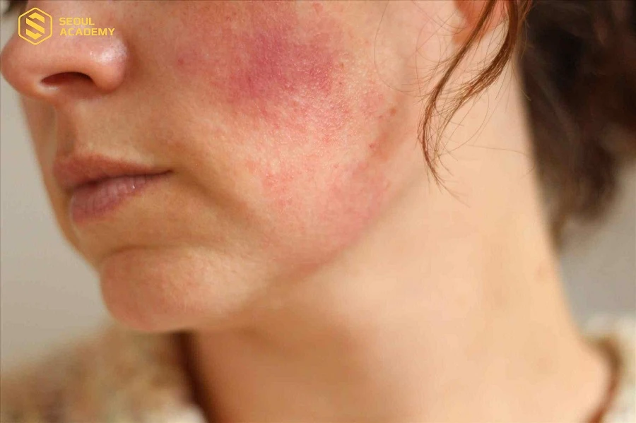 Cai nghiện cho làn da từ từ thay vì ngừng đột ngột