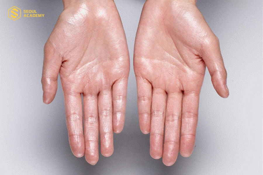 Tay mồ hôi có học spa được không là thắc mắc chung của nhiều người