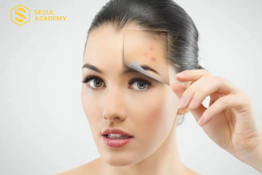 Kem che khuyết điểm có độ che phủ tốt với những nốt mụn sẫm màu