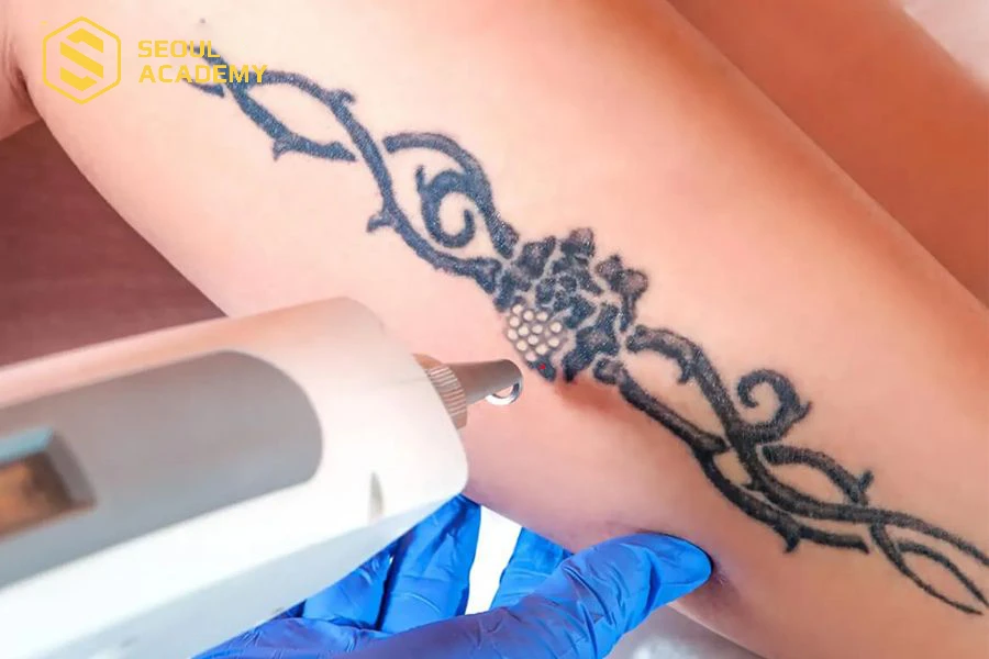 Xóa hình xăm được nhiều người quan tâm khi nhu cầu tăng cao
