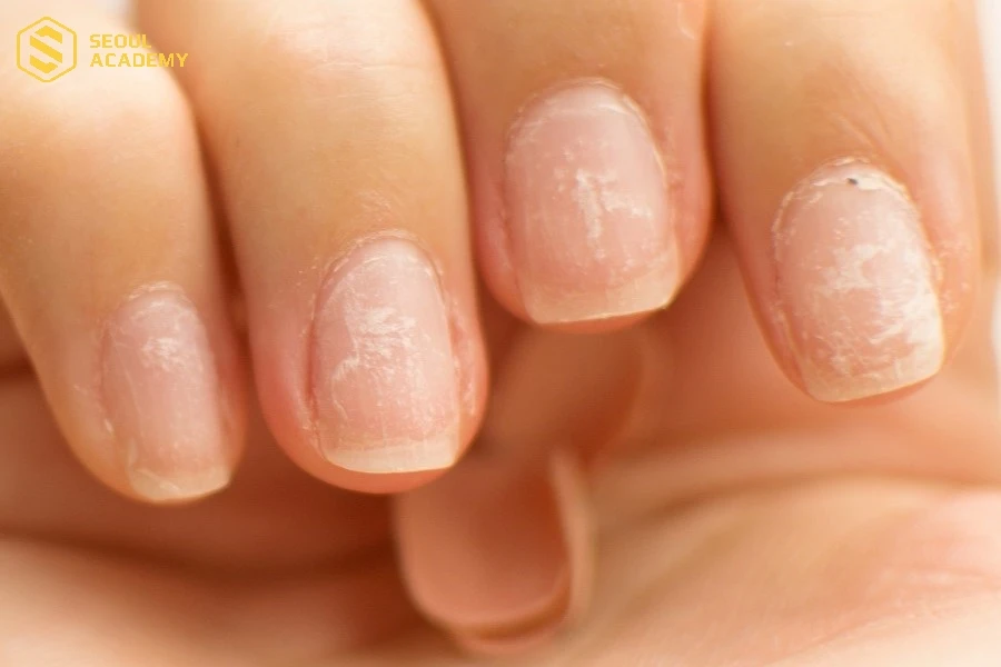 Có nhiều nguyên nhân khiến móng tay bị hư hỏng