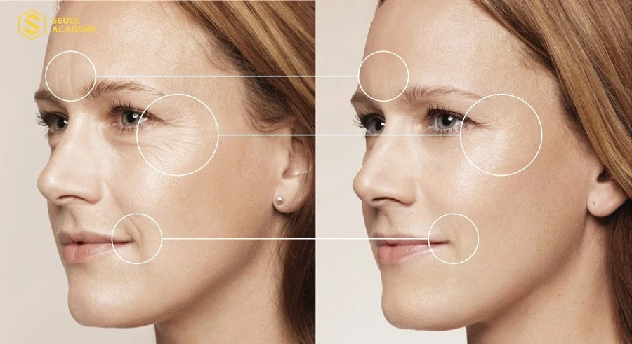 Nâng cơ HIFU có hiệu quả vượt trội nếu áp dụng đúng công nghệ và liệu trình