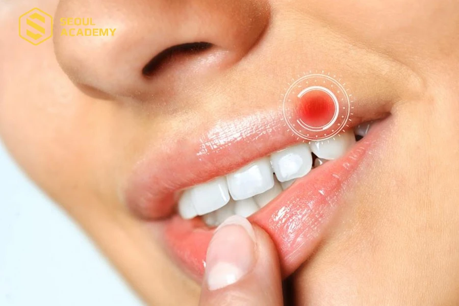 Môi bị sưng và đau nhức khi hiện tượng chảy nước mô xuất hiện