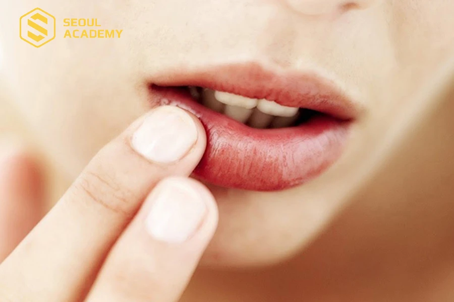 Mật ong hỗ trợ tốt quá trình bong môi sau khi phun