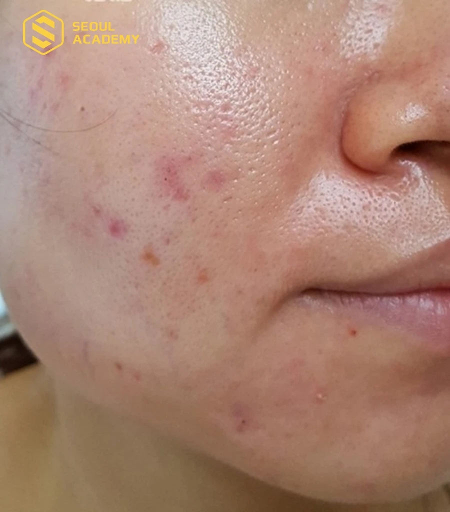 Làn da dầu mụn thường đi kèm với lỗ chân lông to