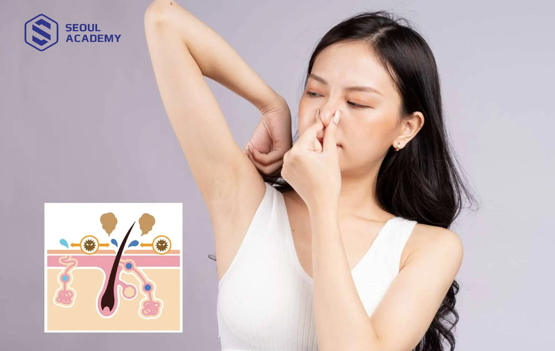 Hôi nách hình thành do vi khuẩn xâm nhập và hoạt động ở tuyến mồ hôi gây mùi