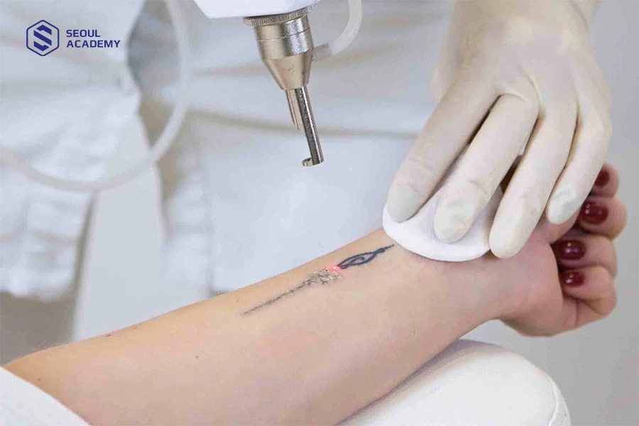 Nên lựa chọn phương pháp xóa xăm hiệu quả thay vì xăm đè lên mực đen