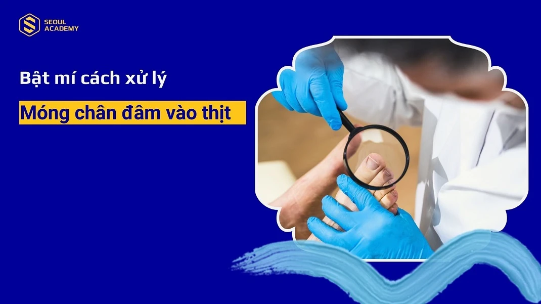 Bật mí cách xử lý móng chân đâm vào thịt không phải ai cũng biết