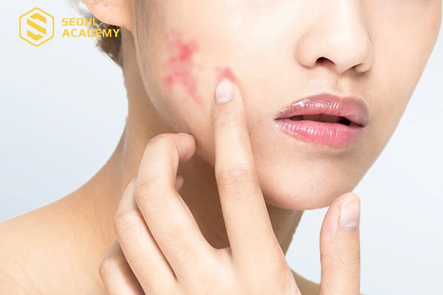 Người có tiền sử dị ứng với các thành phần dưỡng chất trong liệu pháp không nên tiêm meso
