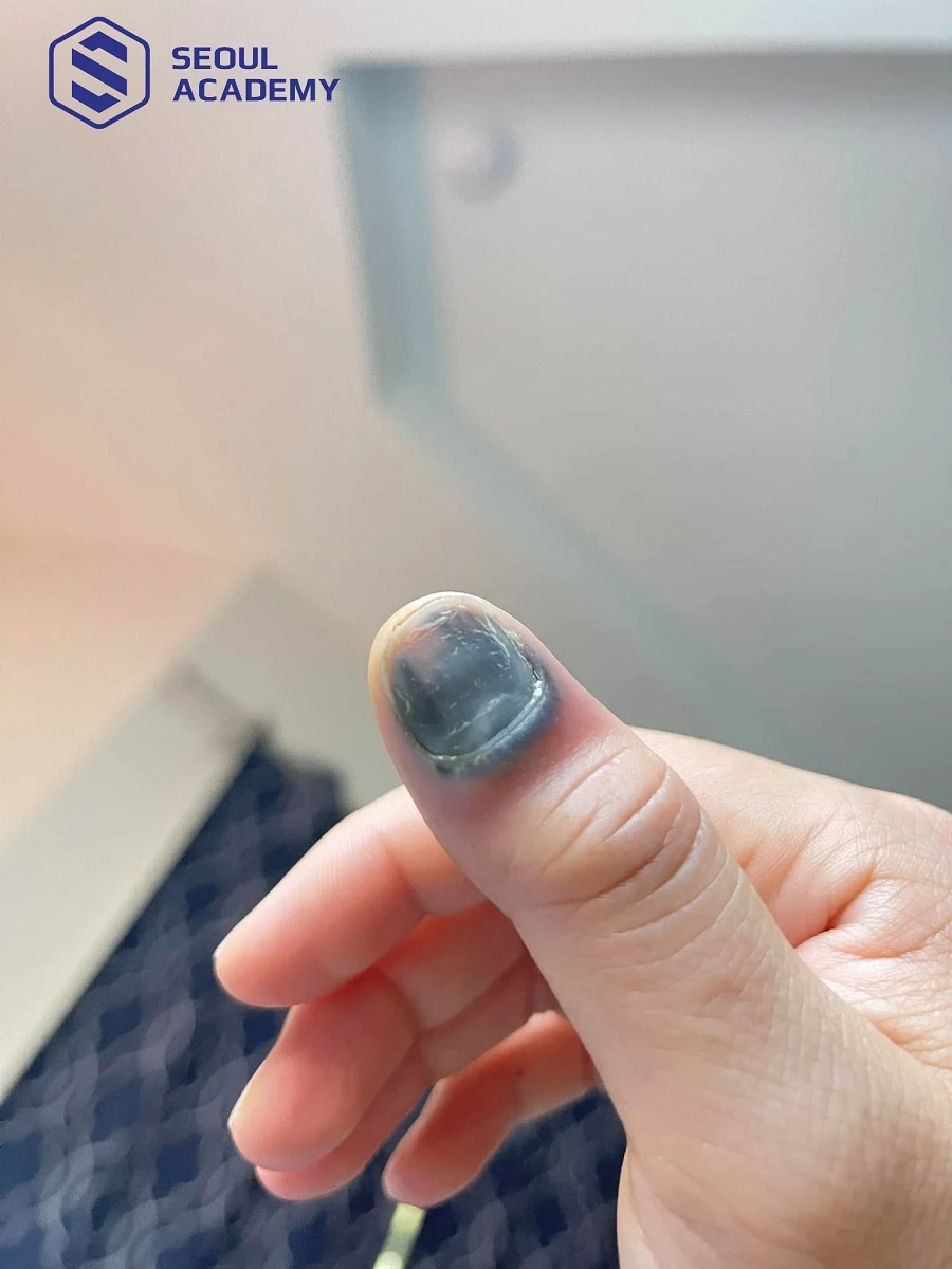 Dập móng là tình trạng móng và mô mềm bên dưới bị tổn thương do tác động từ bên ngoài