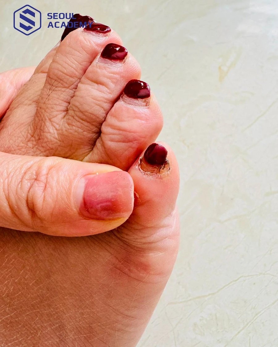 Cố tình làm nail khi móng đang bị tổn thương có thể tiềm ẩn nhiều nguy cơ gây ảnh hưởng đến sự hồi phục của móng