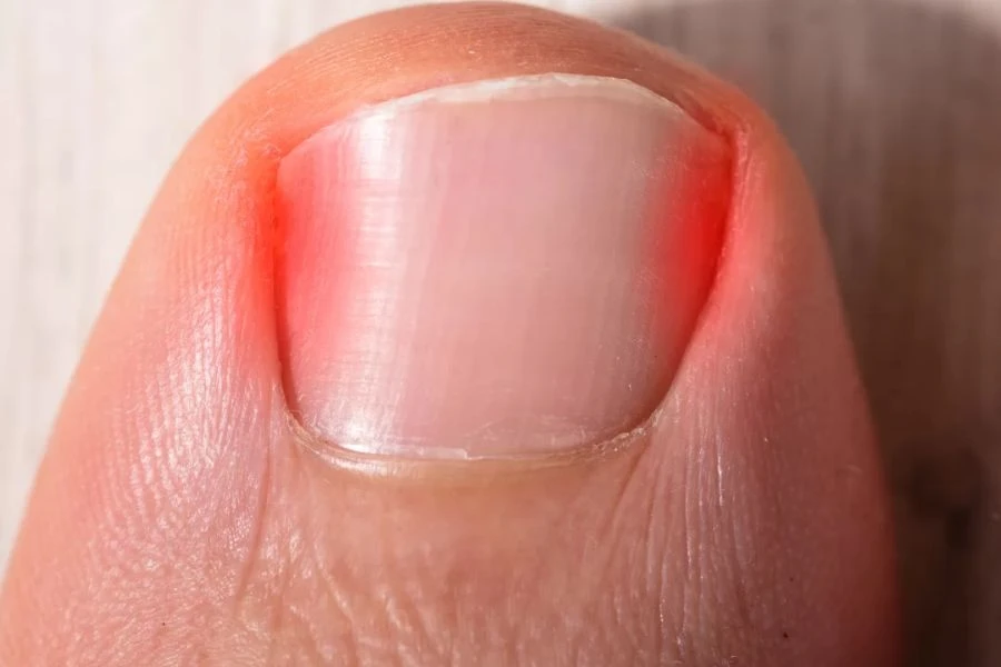 Khóe móng chân là phần rìa ngoài 2 bên của móng