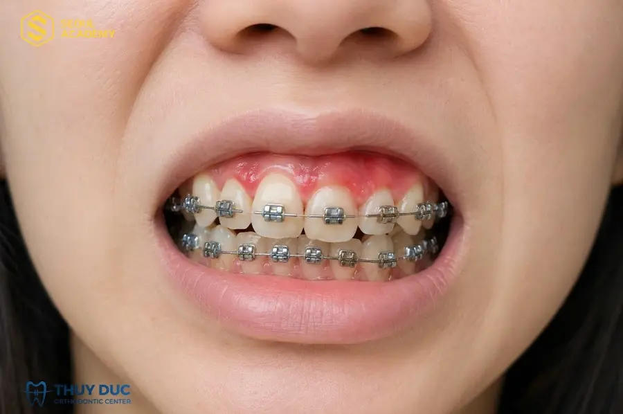 Khi niềng răng môi vốn đã dễ tổn thương hơn so với bình thường kết hợp thêm phun môi càng khiến khu vực miệng tổn thương nhiều hơn