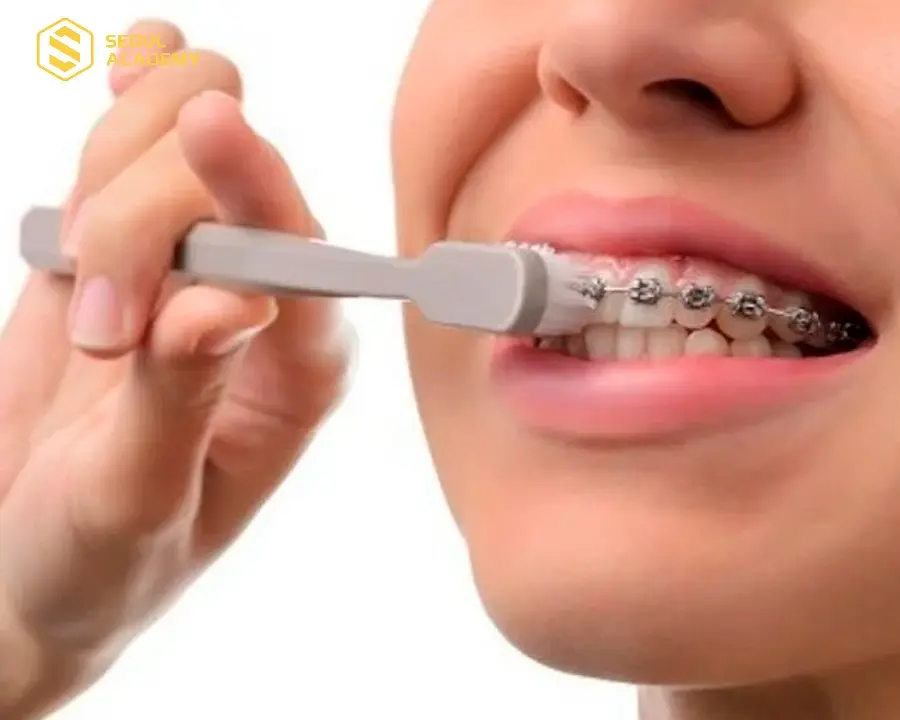 Vừa phun môi vừa niềng răng có nhiều bất tiện trong việc vệ sinh răng miệng