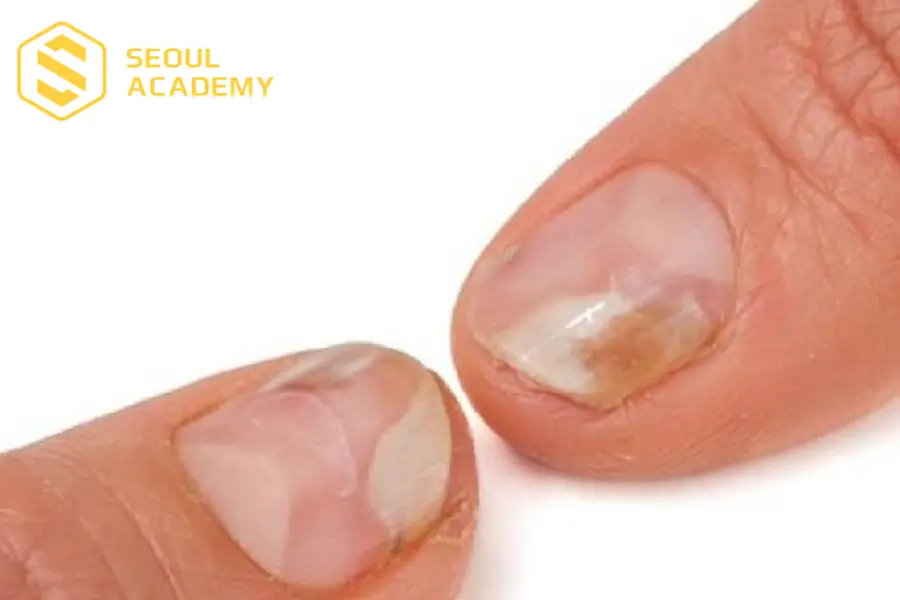 Nấm móng dễ gây ra những biến chứng khác nếu không điều trị kịp thời