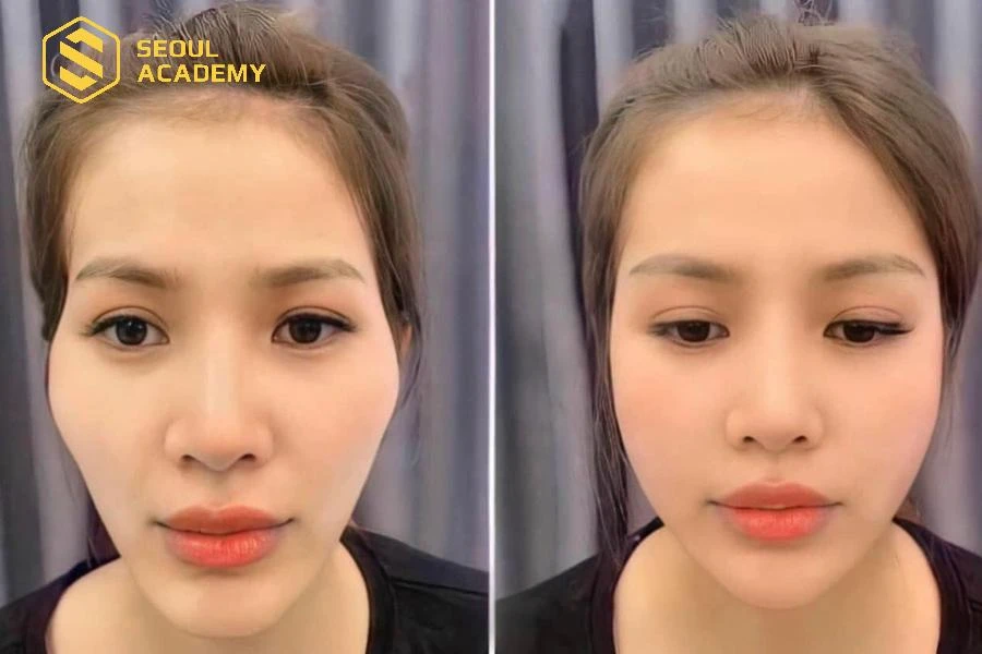 Quá trình thực hiện nhanh chóng, hiệu quả thấy rõ