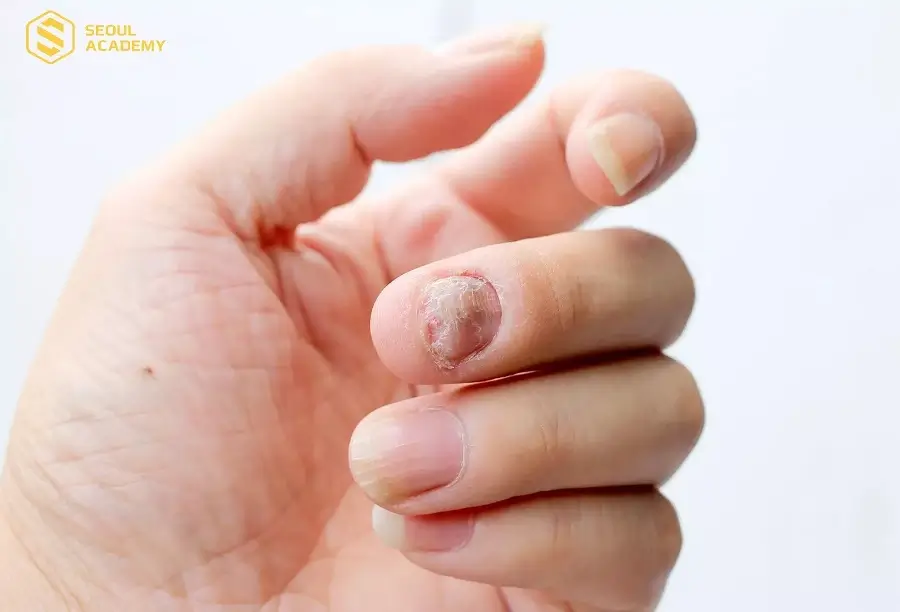 Nếu không tuân thủ quy trình vệ sinh rất có thể tiềm ẩn nguy cơ gây nấm móng, viêm nhiễm móng