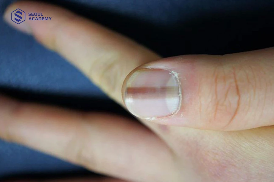 Một số trường hợp móng chân bị sọc đen là dấu hiệu sớm của bệnh ung thư