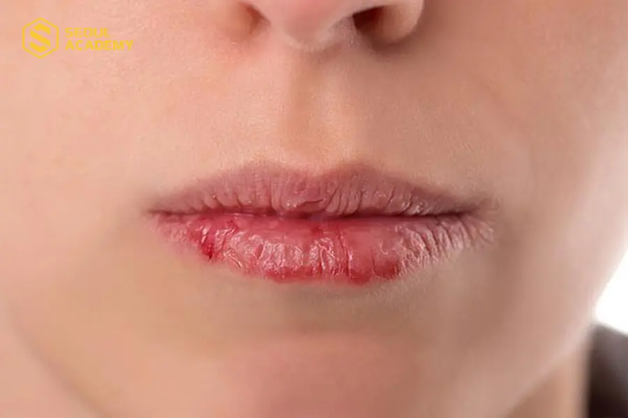 Môi bị nhiễm trùng có thể do sử dụng mực xăm kém chất lượng
