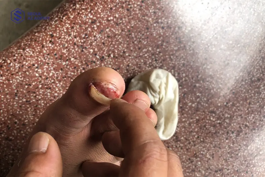Tình trạng móng chân bị bật