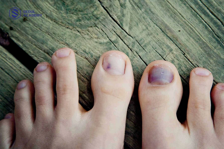 Móng chân bị bật có khả năng mọc lại