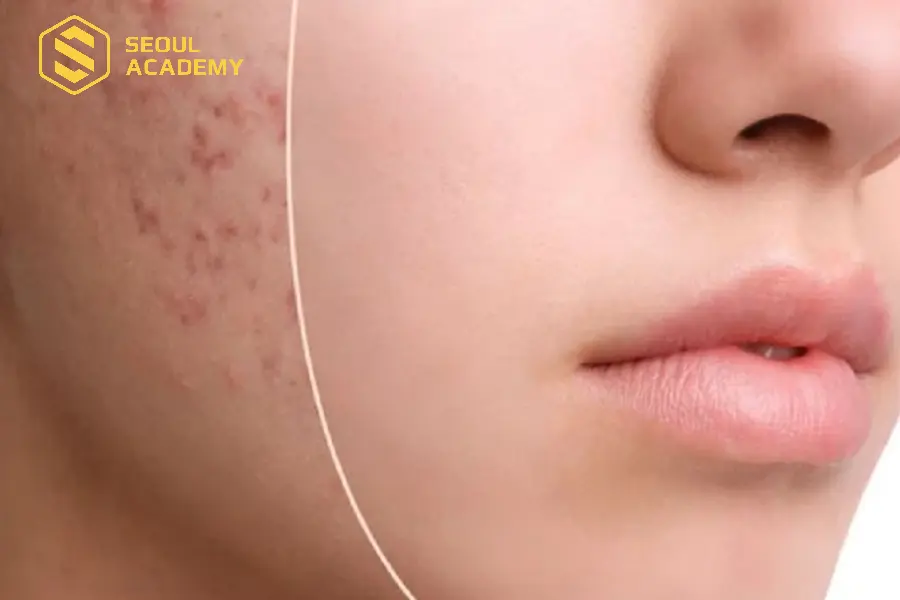 Chuyên đề mụn không thể thiếu khi học dược mỹ phẩm