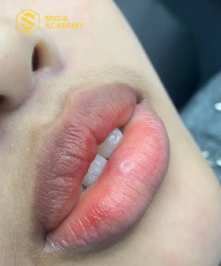 Sau khi khử thâm có những tổn thương nhỏ trên môi cần có thời gian kiêng khem hợp lý