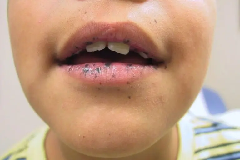Môi xuất hiện vết thâm đen sau khi phun xăm là tình trạng không quá hiếm gặp