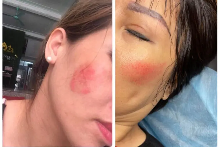 Phun xăm má hồng có thể gây nhiều rủi ro như thâm, sạm, nám