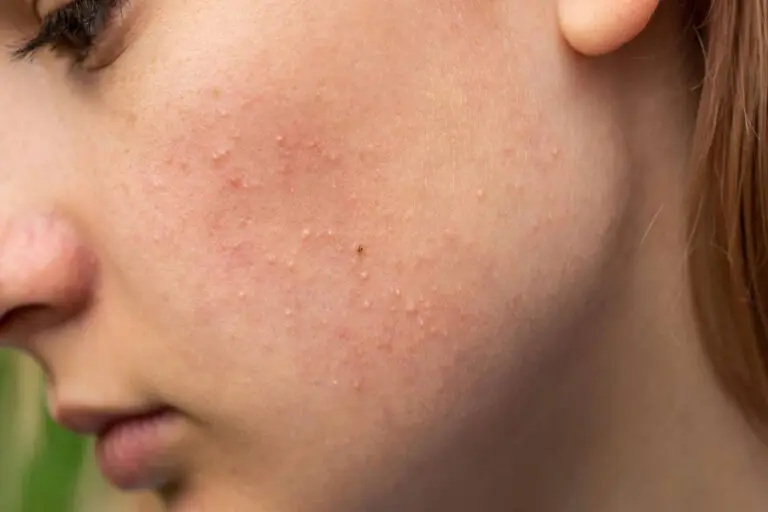 Chị em bị mụn ở má không nên thực hiện