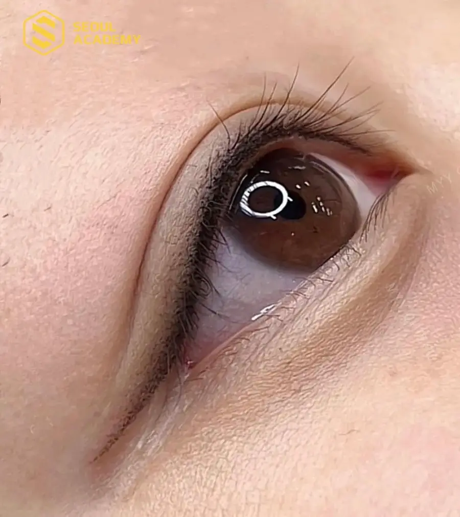 Phun mí mở tròng là lựa chọn khá phổ biến khi mắt bị sụp mí
