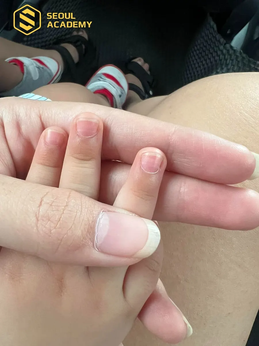 Móng tay ở trẻ em bị lõm có thể là hiện tượng sinh lý bình thường và sẽ hết khi bé lớn hơn