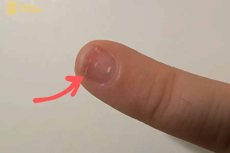 Móng tay bị nứt ngang là tình trạng nhiều người gặp phải
