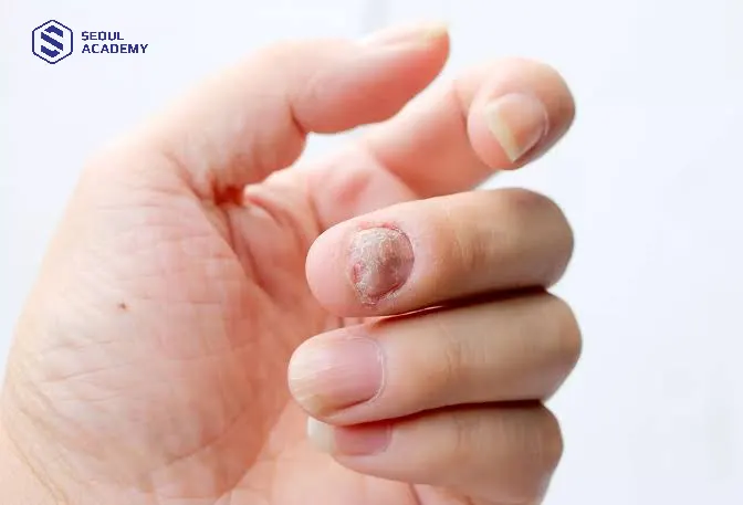 Móng tay xấu là những bộ móng có bề mặt chưa cân đối, hài hòa về mặt thẩm mỹ