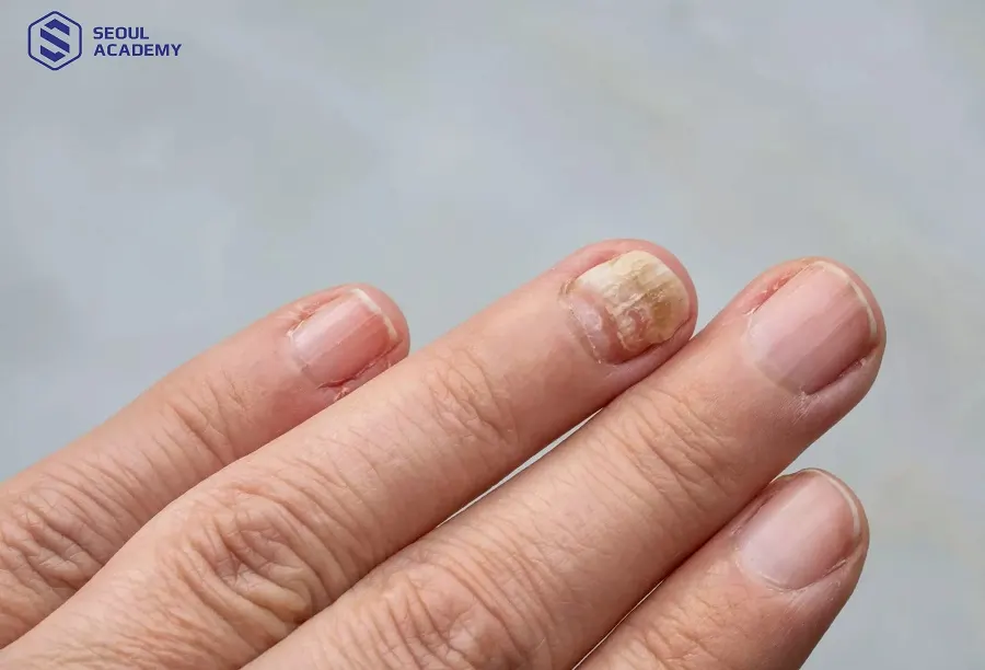 Nếu không đảm bảo vệ sinh có thể tiềm ẩn nguy cơ nấm móng