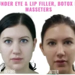lip filler recovery fruits