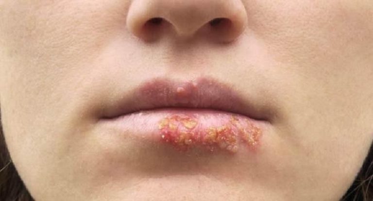 Phun môi nổi mụn liti bao lâu thì khỏi?