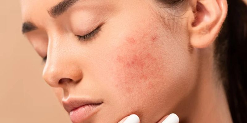 Tác hại của nước tẩy trang sẽ khiến da dễ bị tổn thương