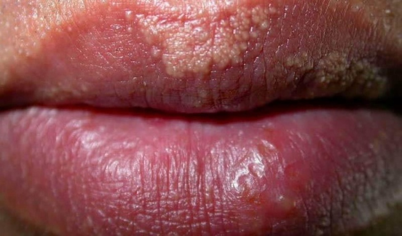 Tình trạng mụn liti gây ảnh hưởng xấu đến đôi môi