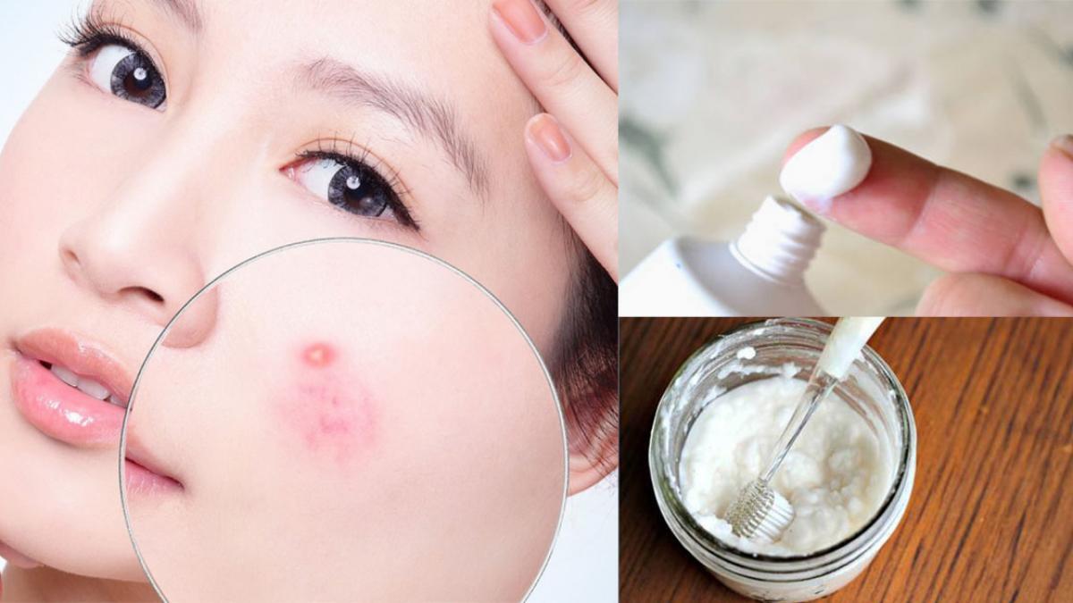Kem đánh răng thường được chỉ định rằng có thể trị mụn cho da