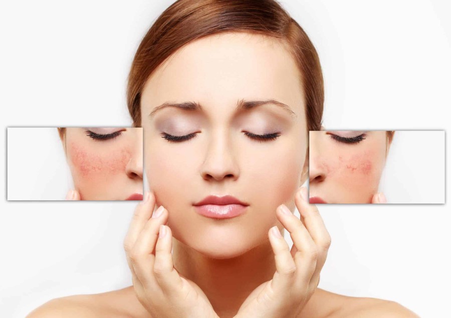 Sử dụng kem đánh răng có thể gây kích ứng cho làn da