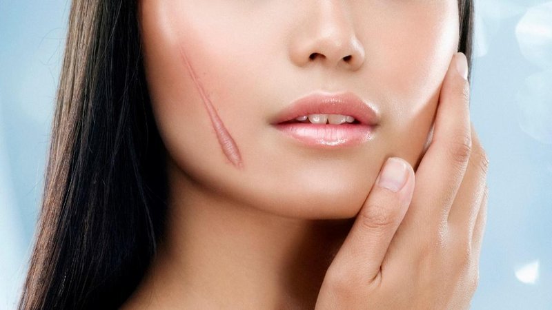 Những vết sẹo còn bị thâm ít và chiều cao từ nhỏ đến trung bình.